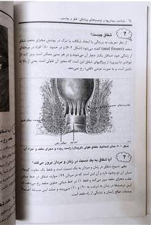 فتق