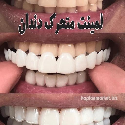 لمینت متحرک دندان ترو اسمایل true smile
